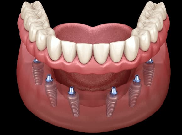 All-on-4 Dental Implants