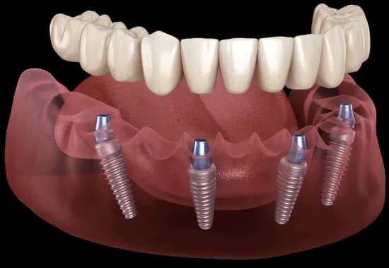 Full Mouth Rehabilitation