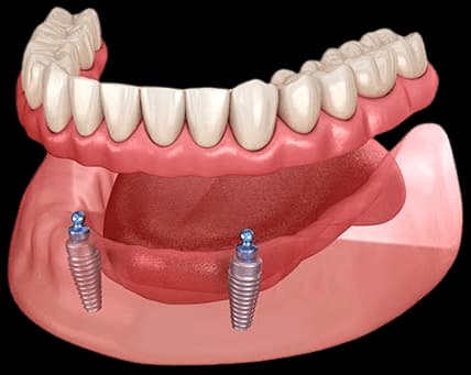 Implant-Supported Dentures
