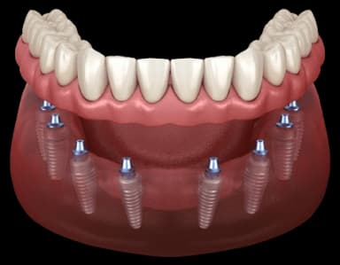 All-On-8 Permanent Teeth